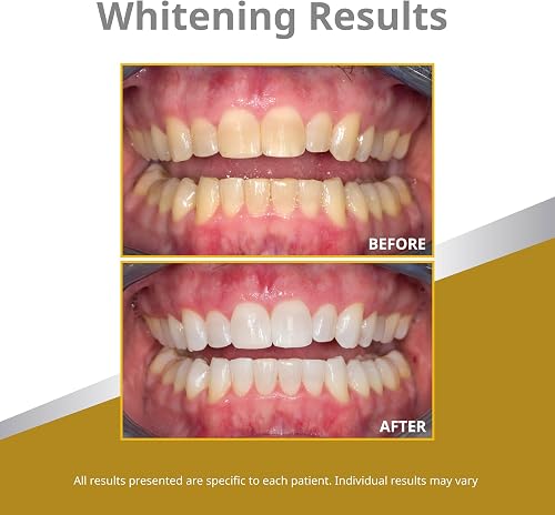 Opalescence listing graphic showing before and after whitening results on a patient